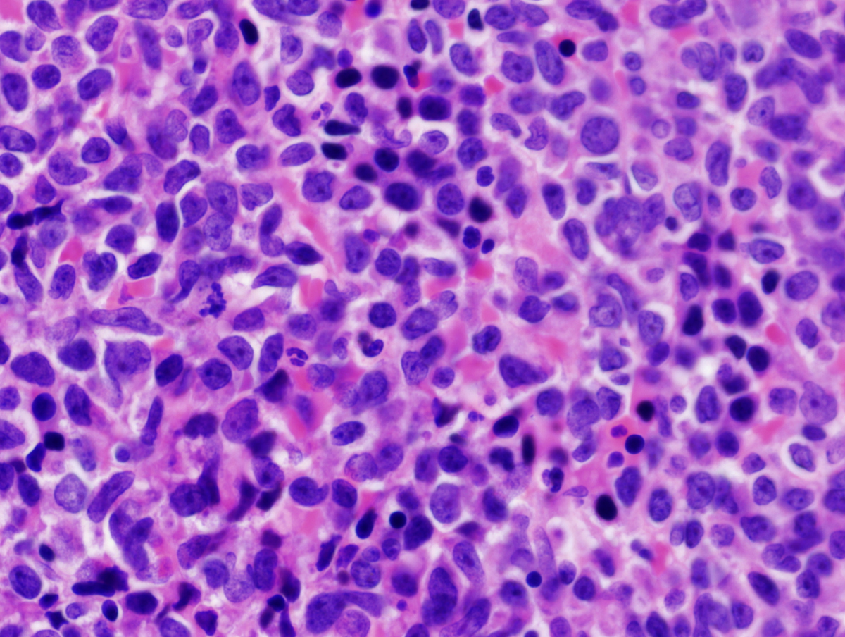 BM biopsy_500x